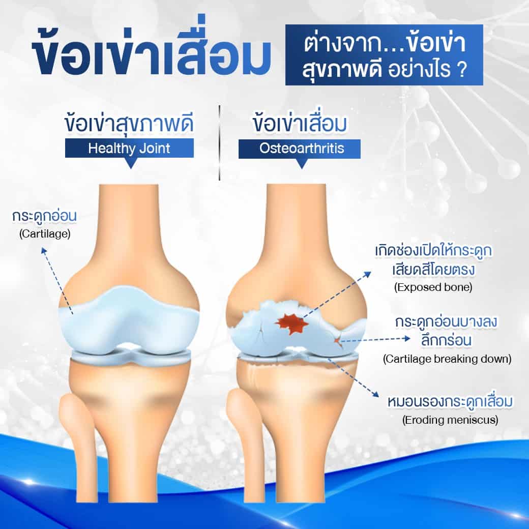 ข้อเข่าเสื่อม